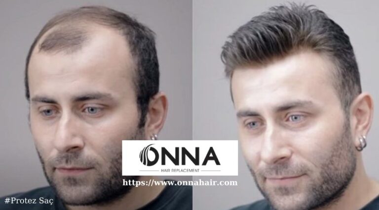 Protez Saç ve Saç Telinin Doğallığını Koruma Yolları