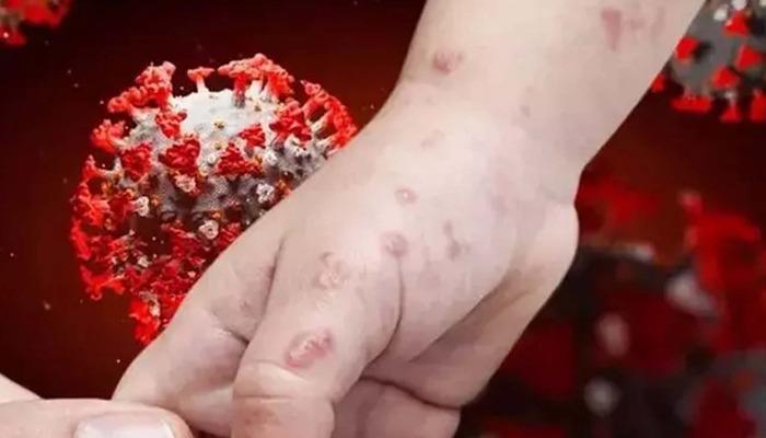 DSÖ’den Maymun çiçeği virüsü için harekete geçti