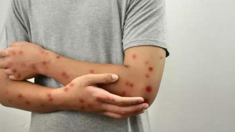 Çocuklarda bu tarz döküntüler varsa aman dikkat! Uzmanı uyardı: Okullarda hızla yayılıyor