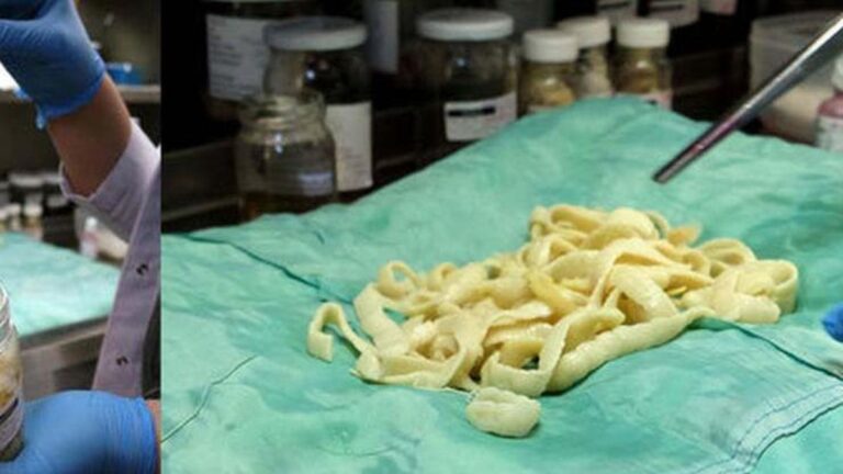 Tenya Nedir, Neden Olur? Tenya Nasıl Dökülür, Tenya Tedavisi Nasıl Yapılır?