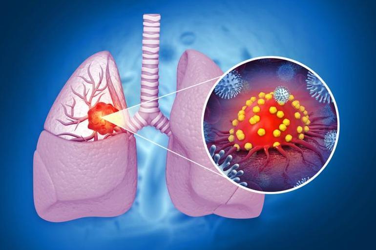 Akciğer kanserinin semptomları nelerdir, akciğer kanseri nasıl anlaşılır tedavi yöntemleri nelerdir?