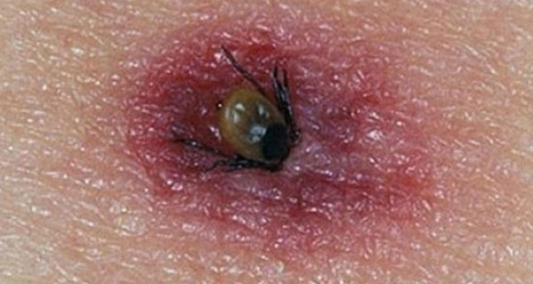 Isırık vakalarında ciddi artış! 15 gün boyunca kan emerek yaşıyorlar: 