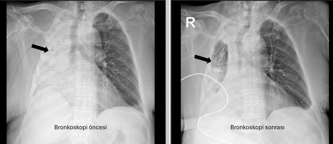 Yedik yiyecek hayatından daha azdı: sağ akciğer tamamen kapalıydı! Trakea'yı engellediğinde 5 ay sonra ortaya çıktı ... 3